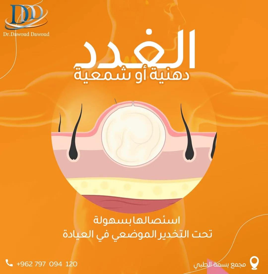 استئصال الغدد الدهنية لدى أفضل جراح في الأردن في عيادة الدكتور داوود داوود في عمان
