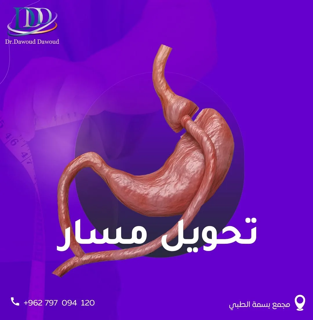 تحويل المسار المصغّر - الدكتور داوود داوود في عمان