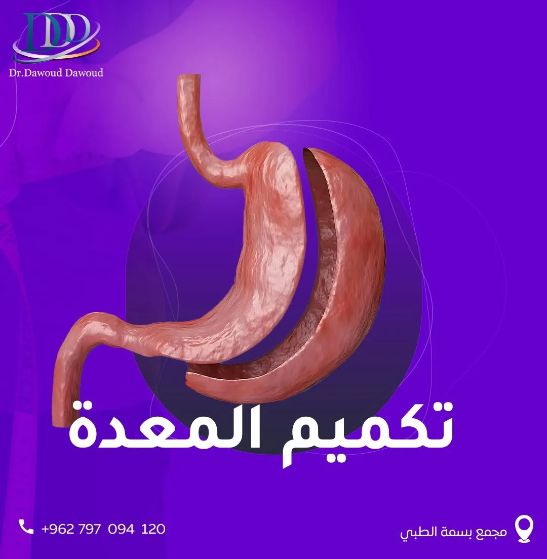 متى يكون تكميم المعدة خيارًا مناسبًا؟
