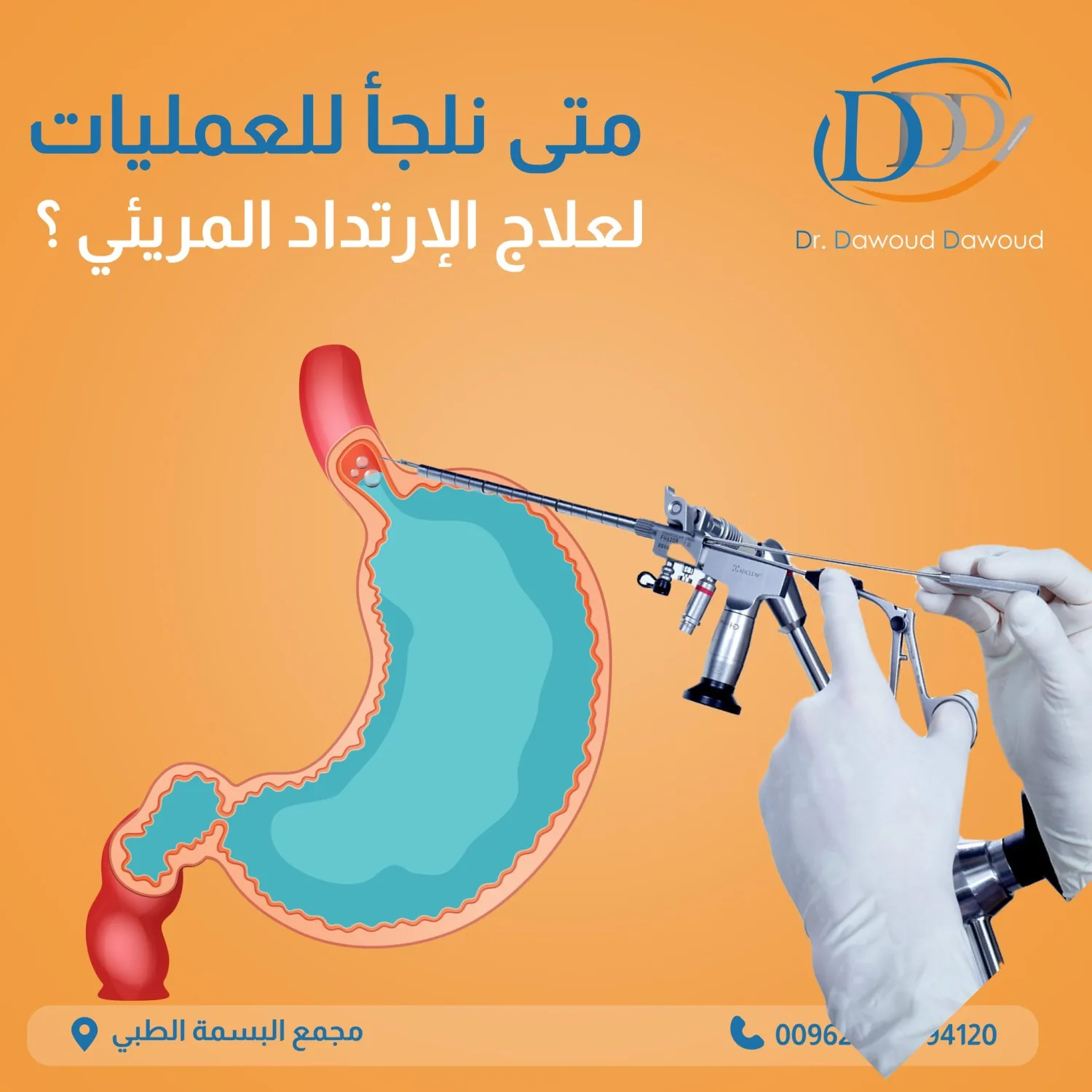 ارتجاع المريء بعد السمنة: متى تحتاج علاجًا؟
