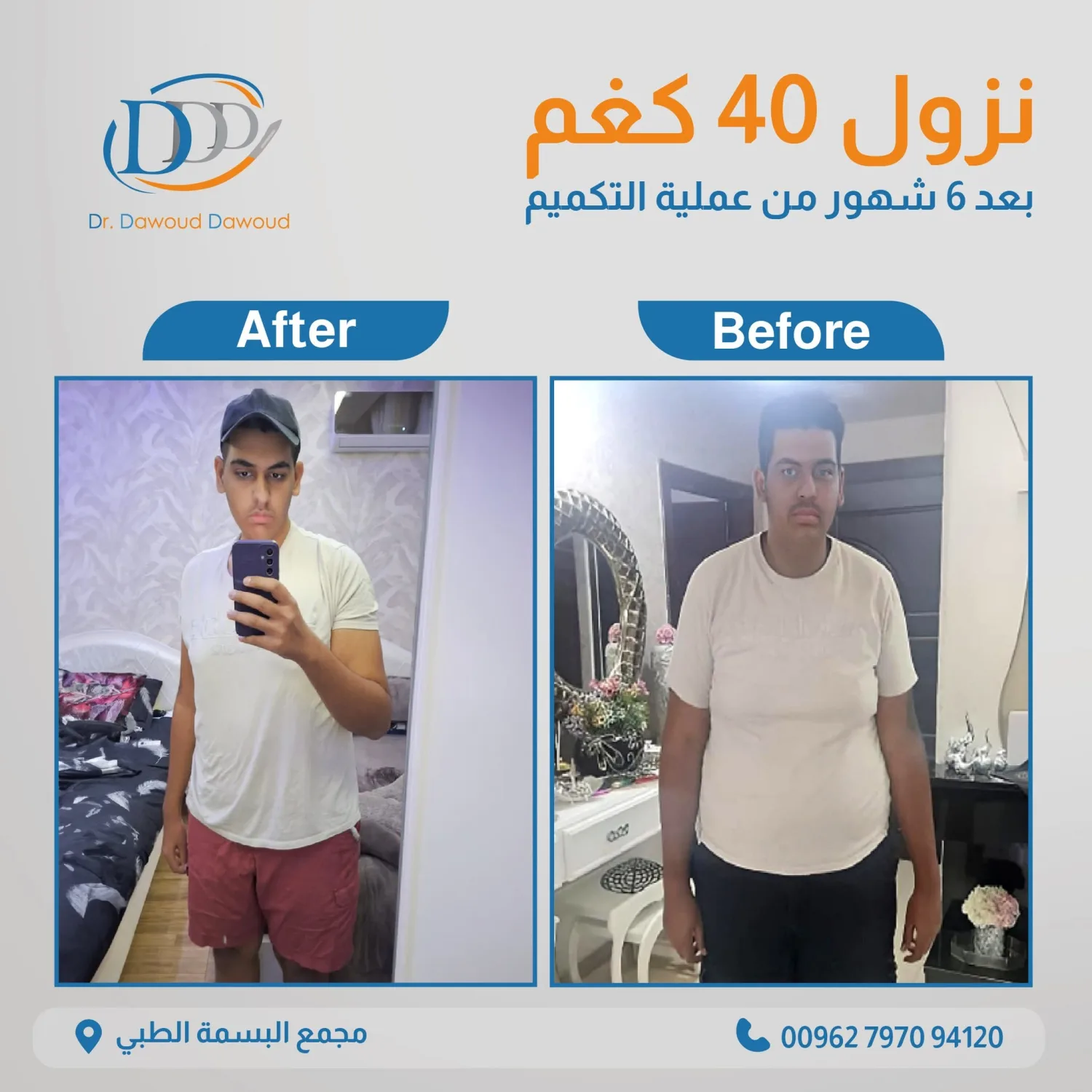 قبل وبعد عمليات السمنة: توقعات واقعية